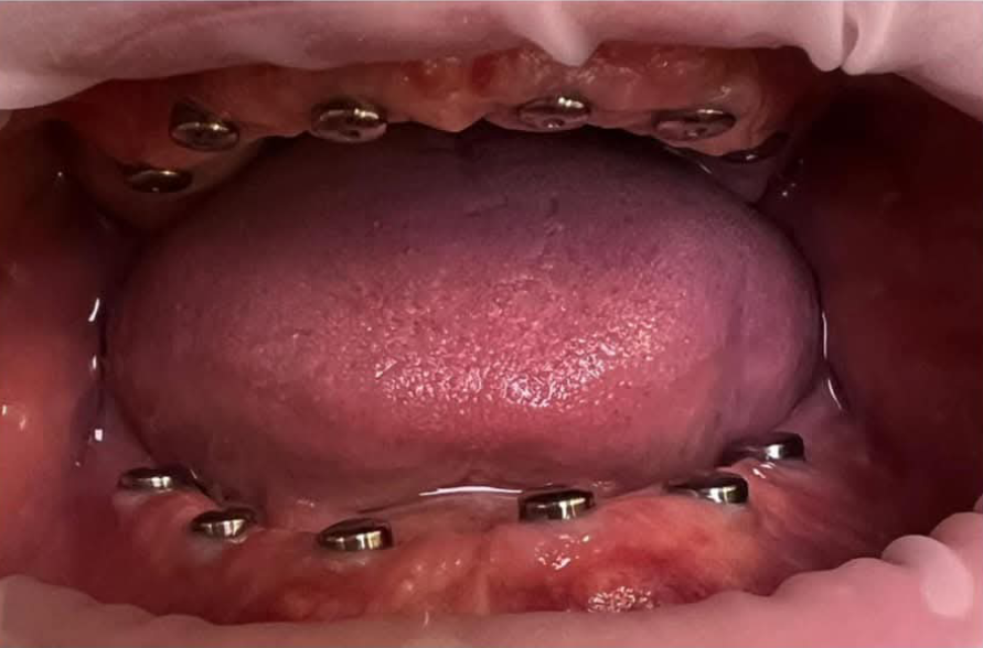 odbudowy pełnołukowe 01