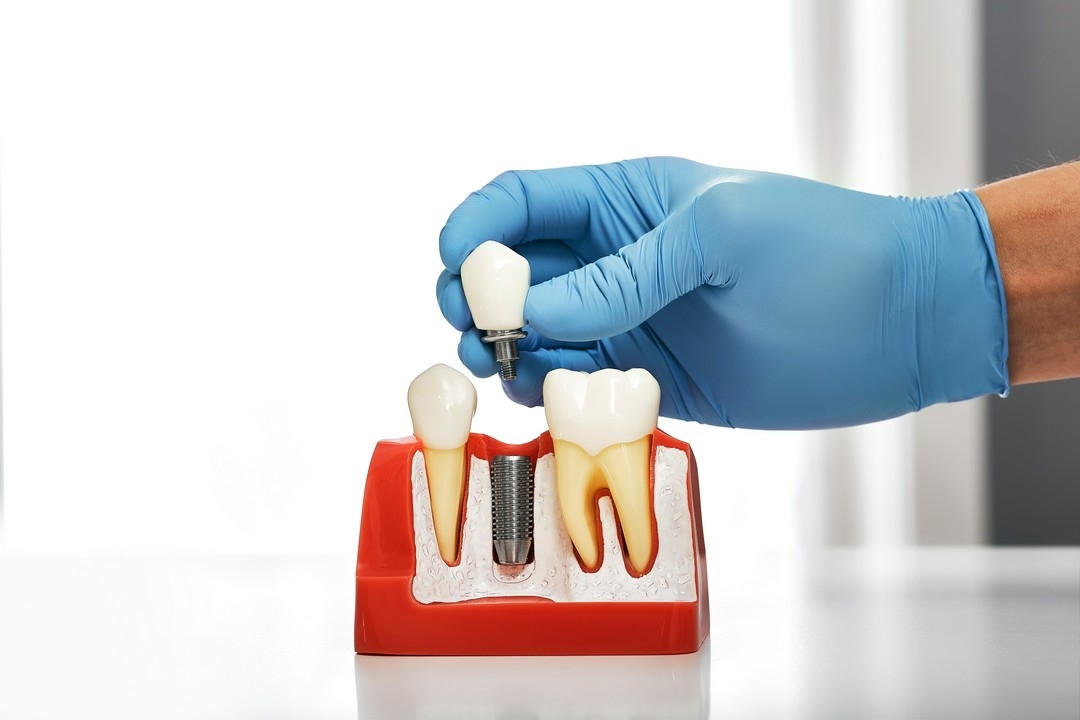 dentyska prezenetuje etap wszepienia implantu dentystycznego