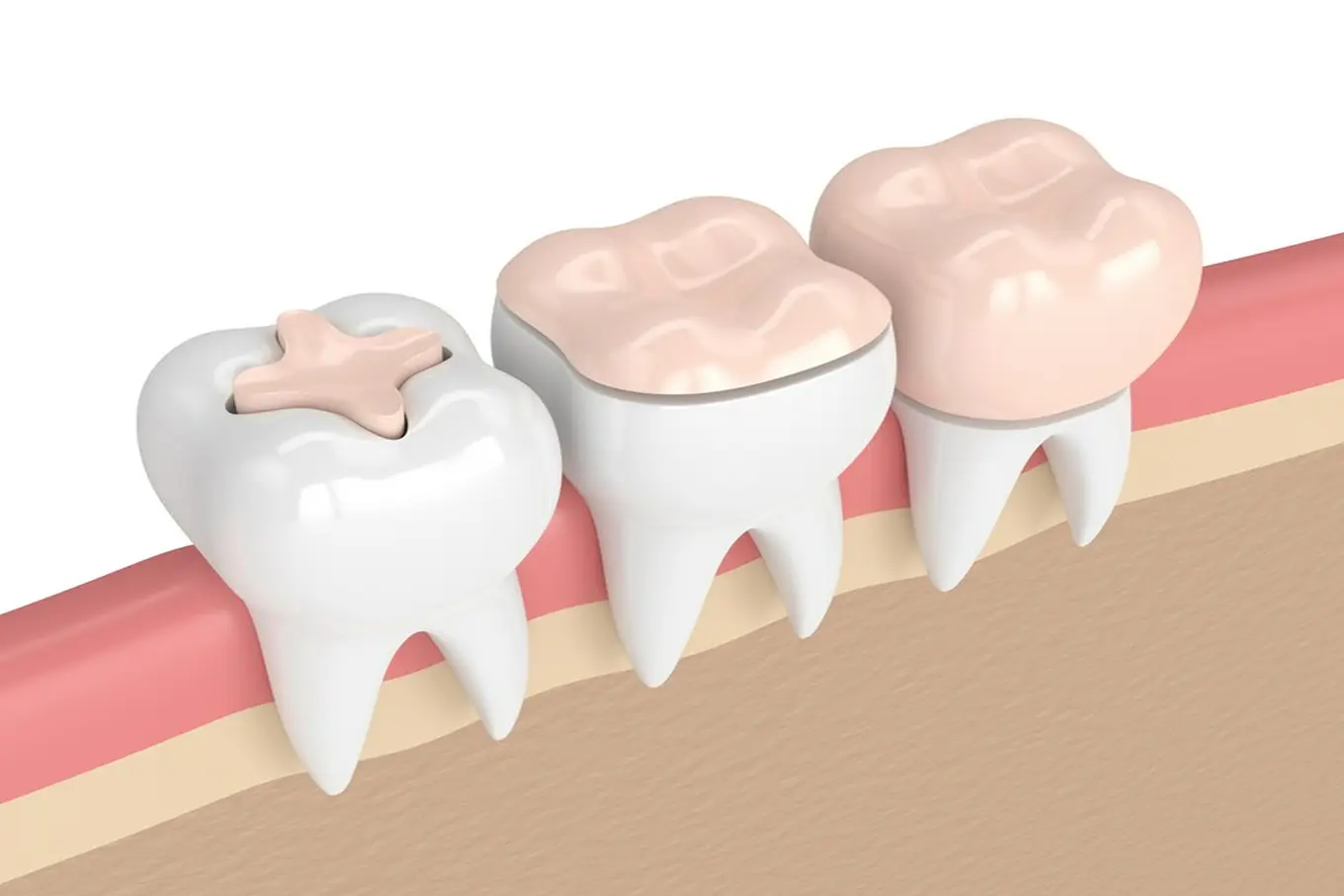 odbudowa protetyczna zębów