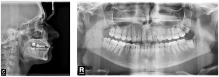 rentgenowskie zdjęcie zębów