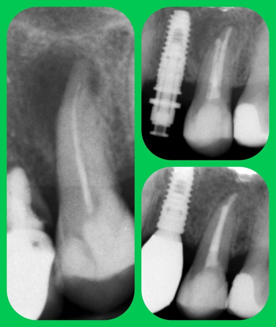 Endodoncja